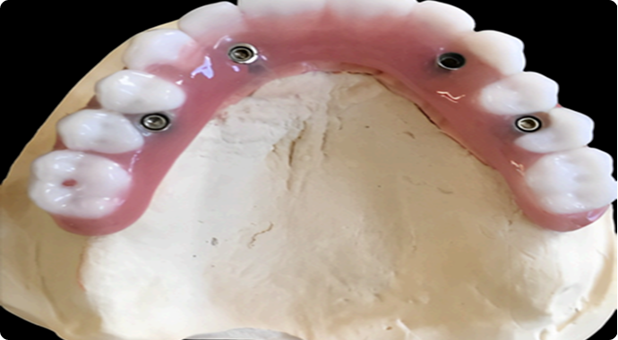 Implants Service